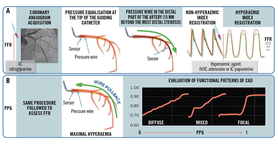 Expert review: Physiology-guided management of MVD in ACS patients