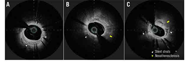 Original research: Impact of ACS on neoatherosclerosis