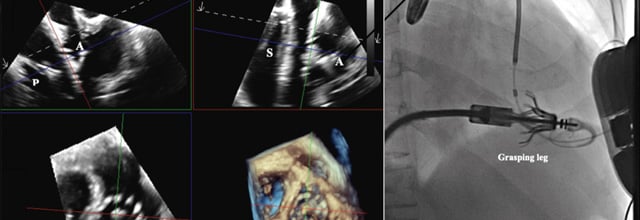 Flashlight: Cardiovalve system for tricuspid valve implantation