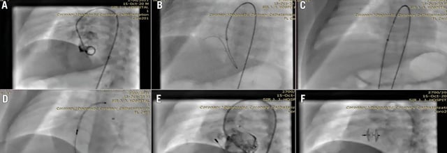 Research Correspondence: Percutaneous device closure